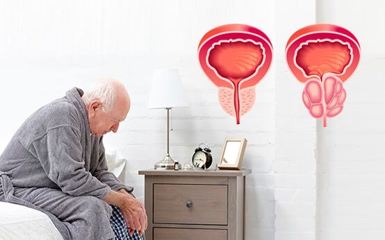 προστατίτιδα σε έναν άνδρα